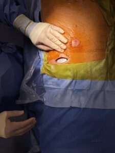 Robert Moghim, M.D. Closing surgically on a cervical placement while