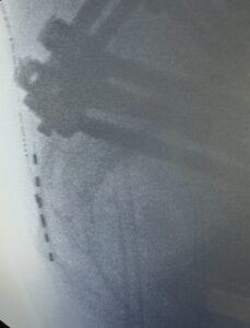 Real or made up? Is the middle cluneal nerve and