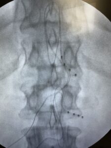 📢 Dorsal Root Ganglion (DRG) stimulation continues to expand beyond its original indications. While FDA approval was established f…