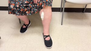 Medicare Patient with BMI >50 with bone on bone knee arthritis. Injections and medications aren’t working. Weight loss has been di…