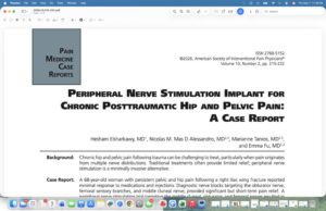 Obturator and femoral sensory branches, PNS implant can be therapeutic option for patients with refractory hip pain , please see o…