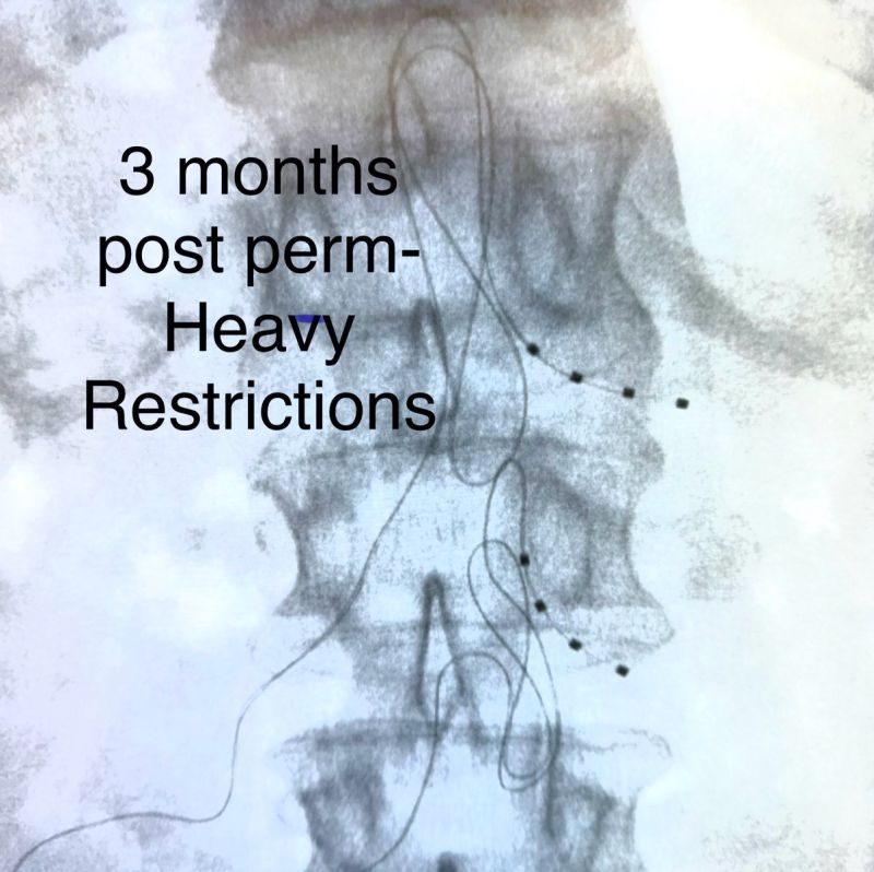 What do you do with a highly active patient after DRG stimulation?